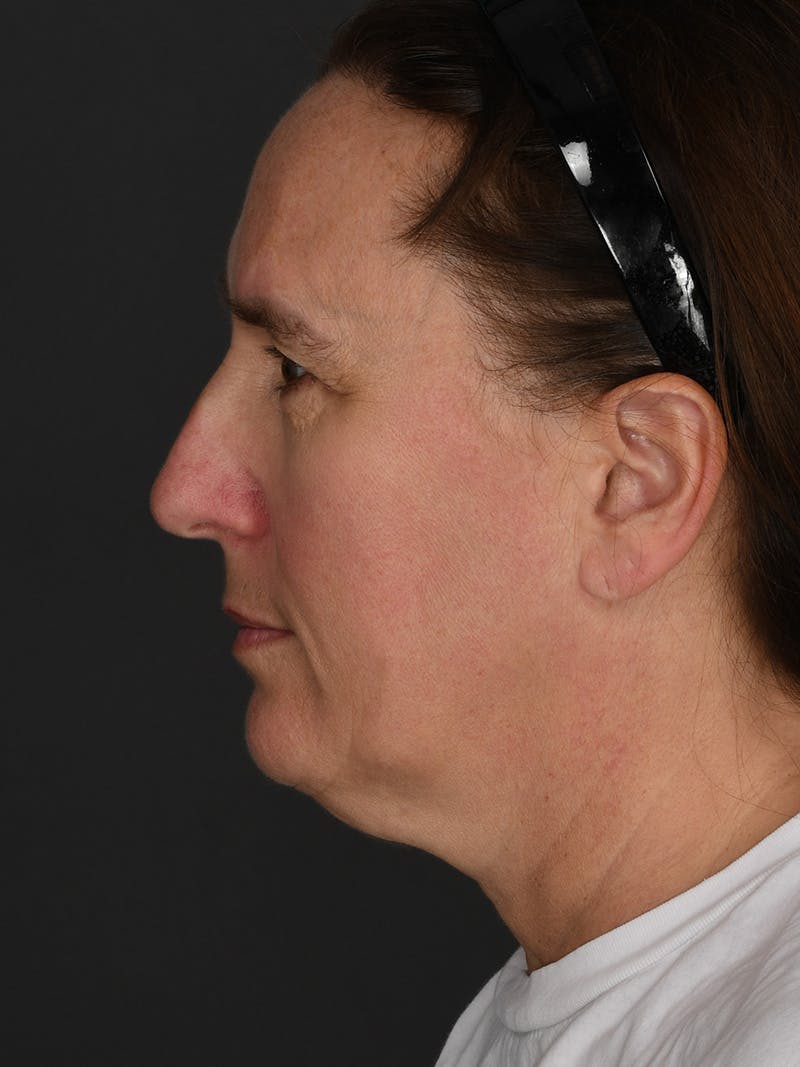 Composite Facelift Before & After Gallery - Patient 334203 - Image 3