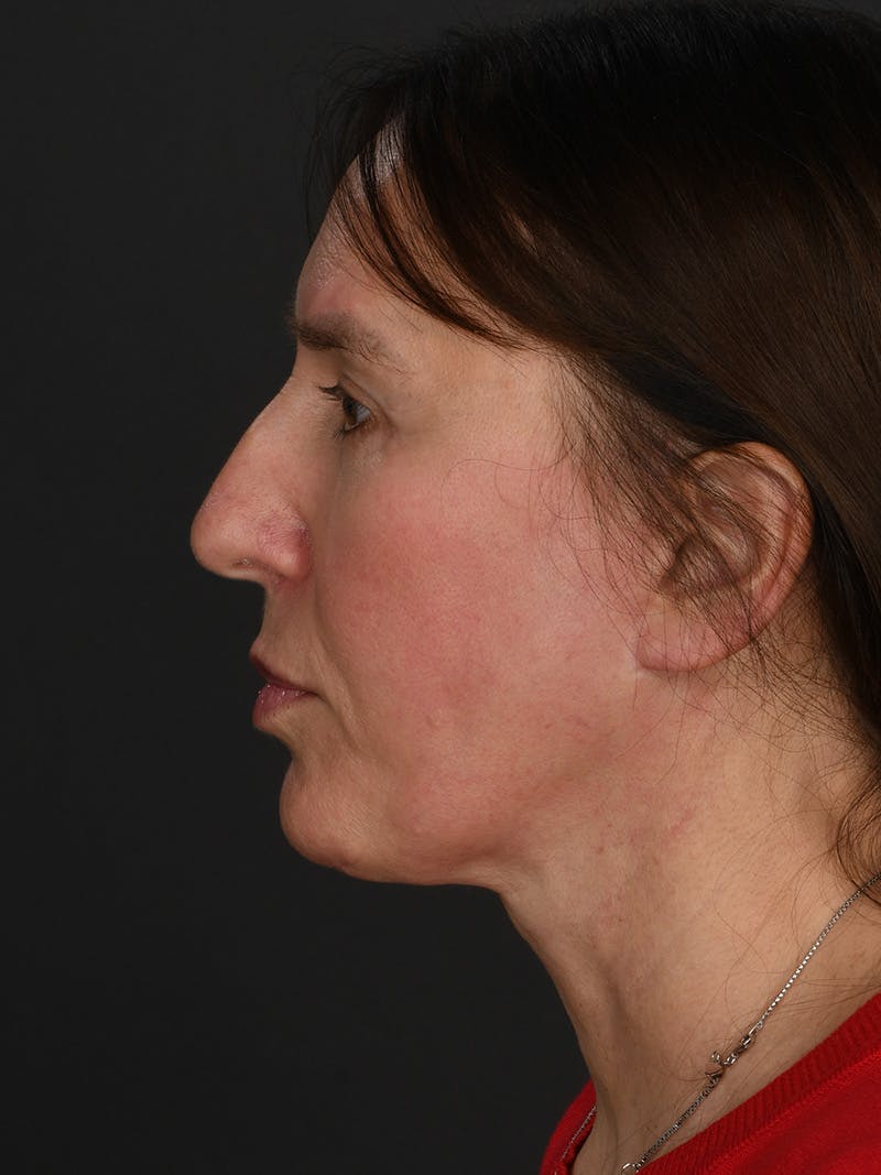 Composite Facelift Before & After Gallery - Patient 334203 - Image 4
