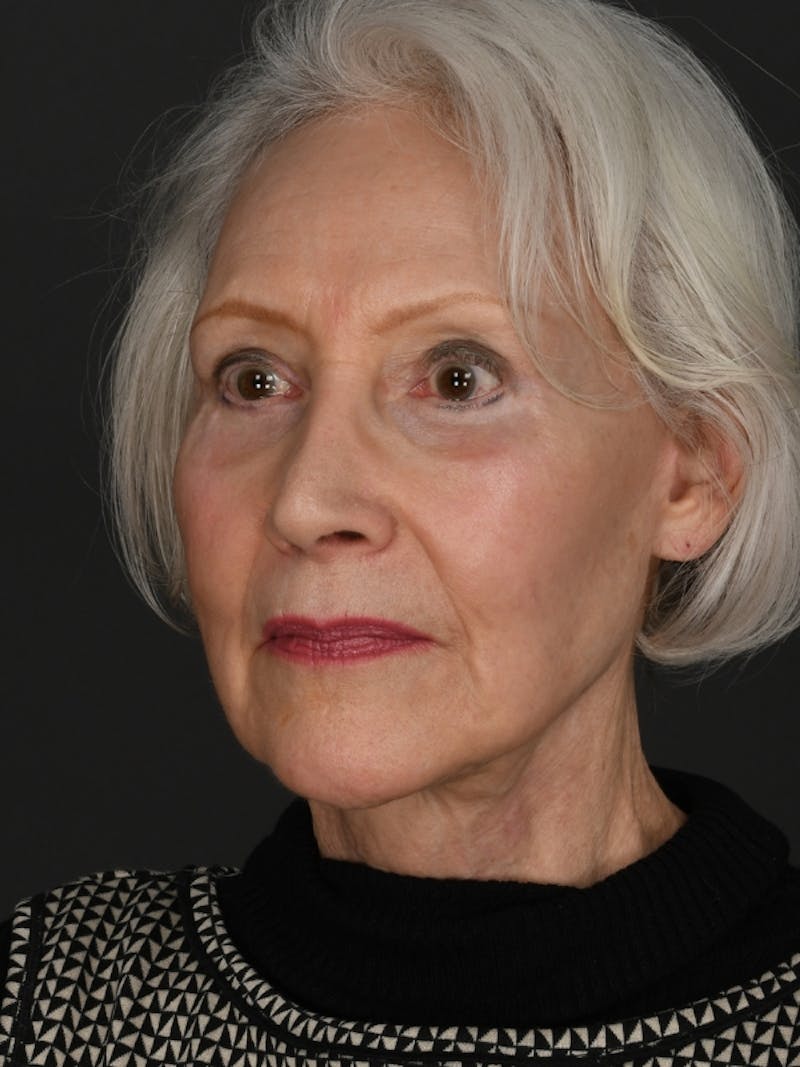 Composite Facelift Before & After Gallery - Patient 101830 - Image 2