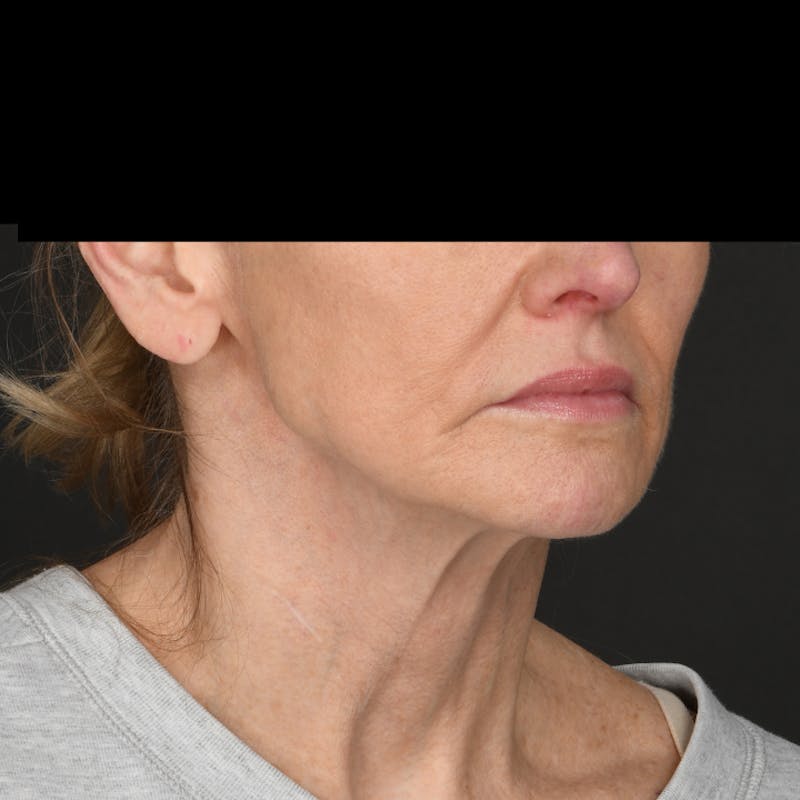 Neck Lift Before & After Gallery - Patient 423979 - Image 1