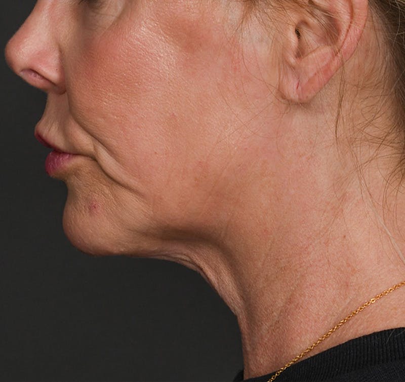 Neck Lift Before & After Gallery - Patient 523985 - Image 1