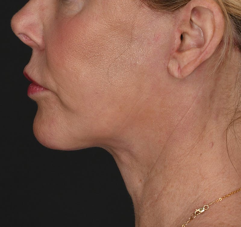Neck Lift Before & After Gallery - Patient 523985 - Image 2