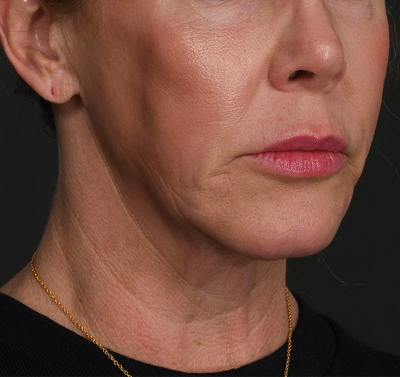 Neck Lift Before & After Gallery - Patient 523985 - Image 3