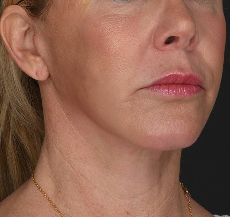 Neck Lift Before & After Gallery - Patient 523985 - Image 4