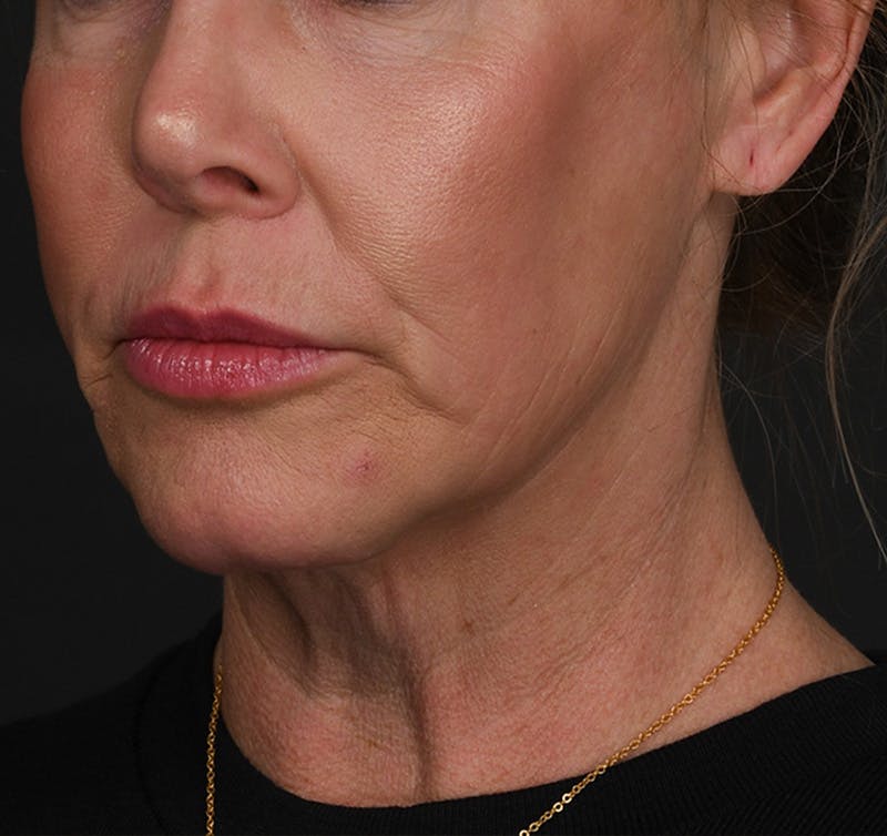 Neck Lift Before & After Gallery - Patient 523985 - Image 5