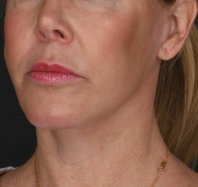 Neck Lift Before & After Gallery - Patient 523985 - Image 6