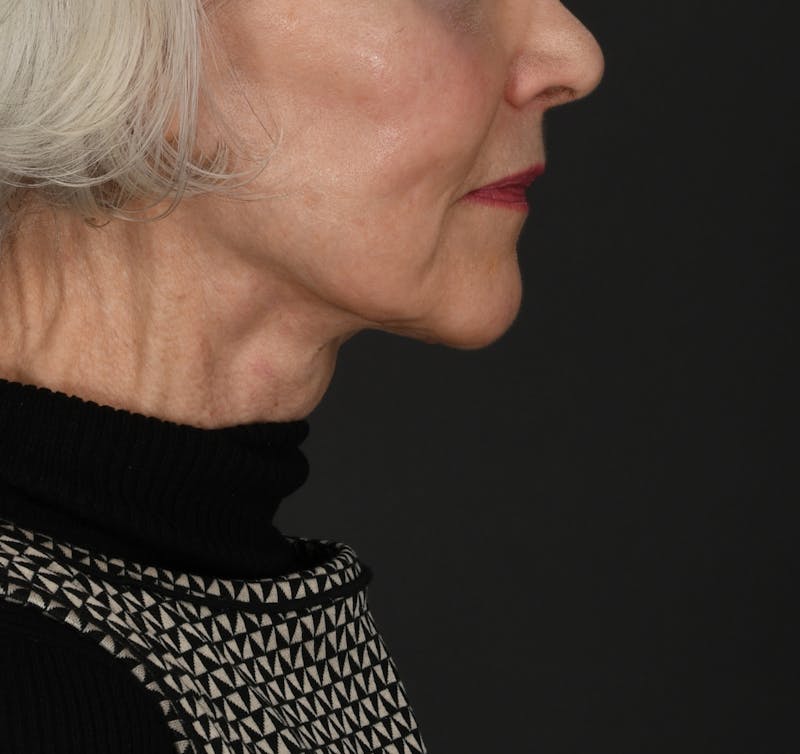 Neck Lift Before & After Gallery - Patient 331179 - Image 2