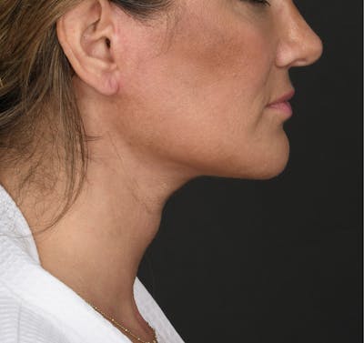 Neck Lift Before & After Gallery - Patient 395901 - Image 2