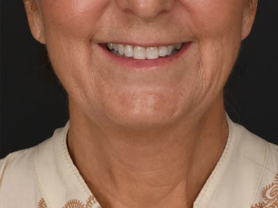 Neck Lift Before & After Gallery - Patient 303674 - Image 1