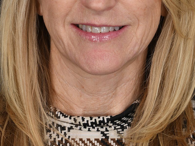 Neck Lift Before & After Gallery - Patient 357860 - Image 2