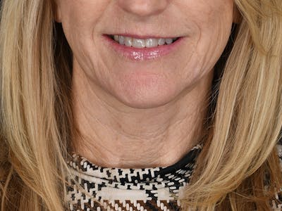 Neck Lift Before & After Gallery - Patient 357860 - Image 2