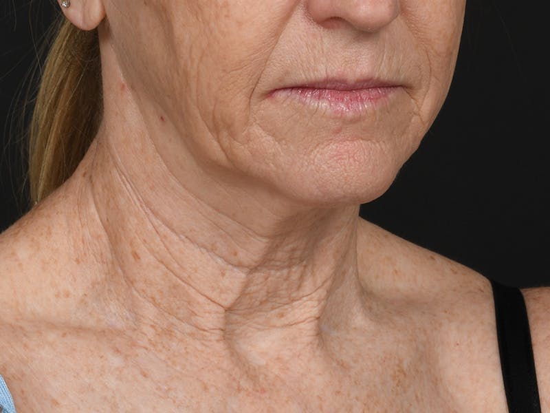 Neck Lift Before & After Gallery - Patient 357860 - Image 3