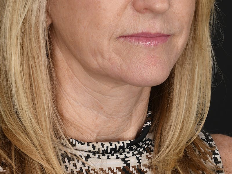 Neck Lift Before & After Gallery - Patient 357860 - Image 4