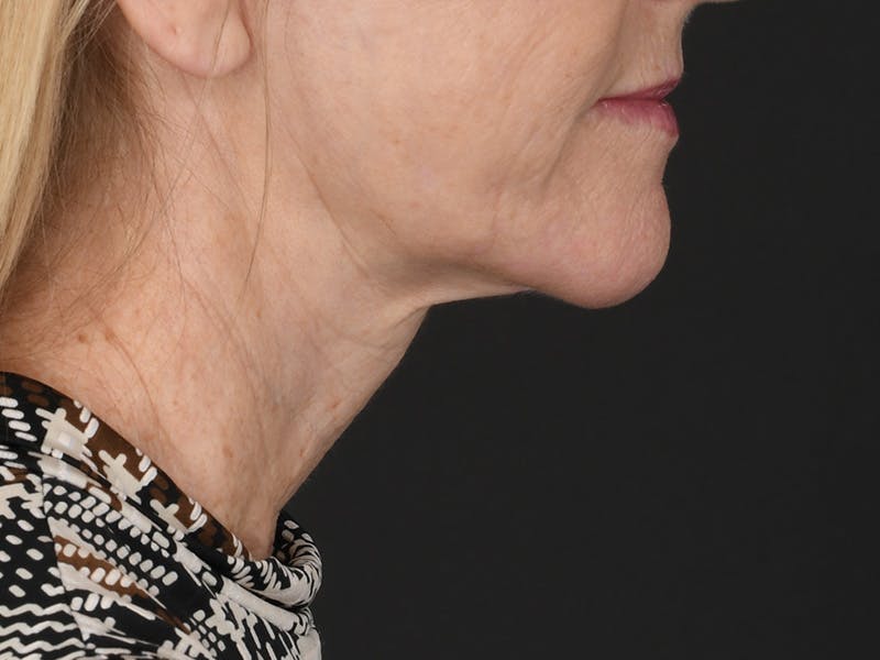 Neck Lift Before & After Gallery - Patient 357860 - Image 6