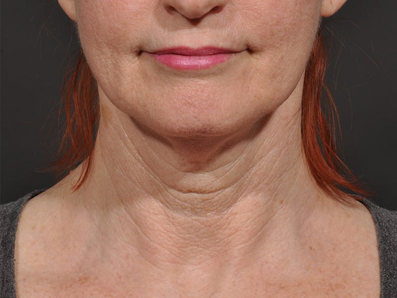 Neck Lift Before & After Gallery - Patient 148675 - Image 1