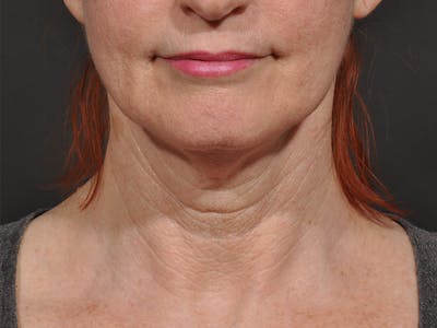 Neck Lift Before & After Gallery - Patient 148675 - Image 1
