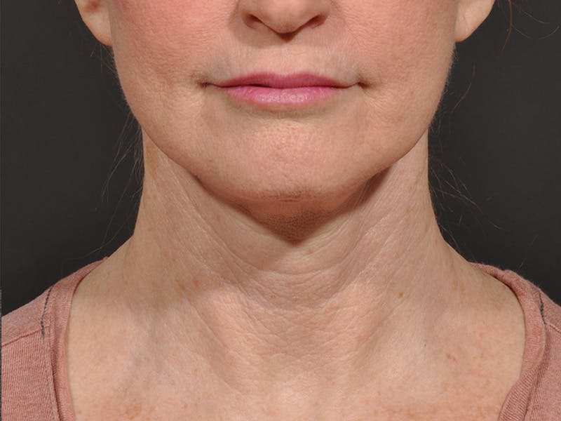 Neck Lift Before & After Gallery - Patient 148675 - Image 2