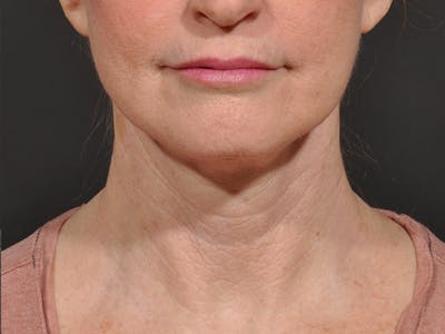 Neck Lift Before & After Gallery - Patient 148675 - Image 2