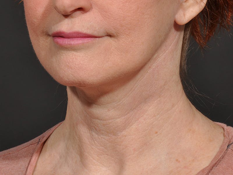Neck Lift Before & After Gallery - Patient 148675 - Image 4