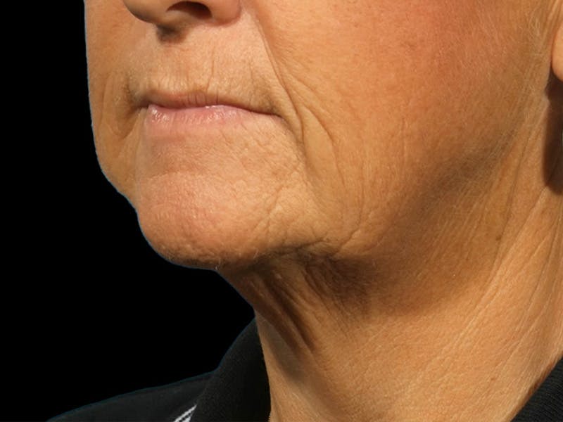 Neck Lift Before & After Gallery - Patient 269968 - Image 1