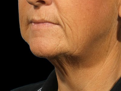Neck Lift Before & After Gallery - Patient 269968 - Image 1