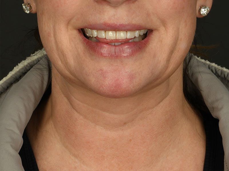 Neck Lift Before & After Gallery - Patient 140653 - Image 3