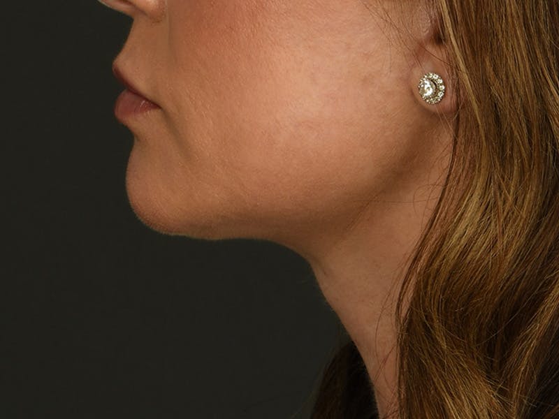 Neck Lift Before & After Gallery - Patient 140653 - Image 6