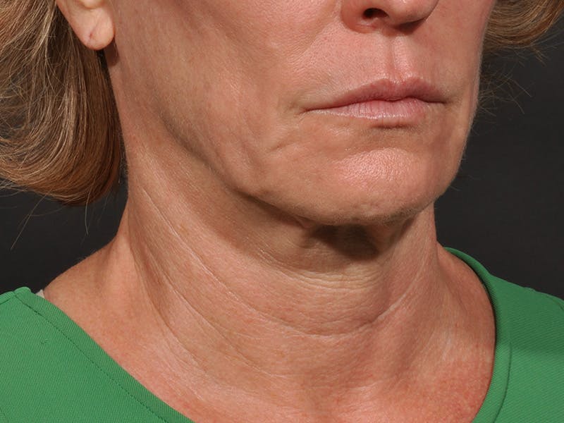 Neck Lift Before & After Gallery - Patient 194051 - Image 1