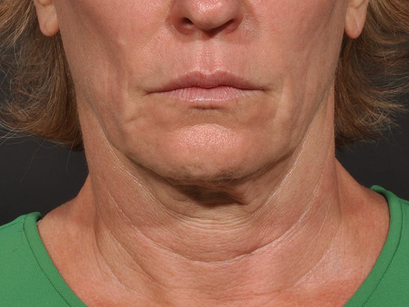 Neck Lift Before & After Gallery - Patient 194051 - Image 5