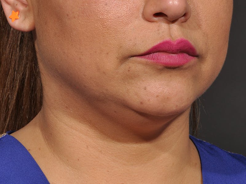 Neck Lift Before & After Gallery - Patient 333737 - Image 1