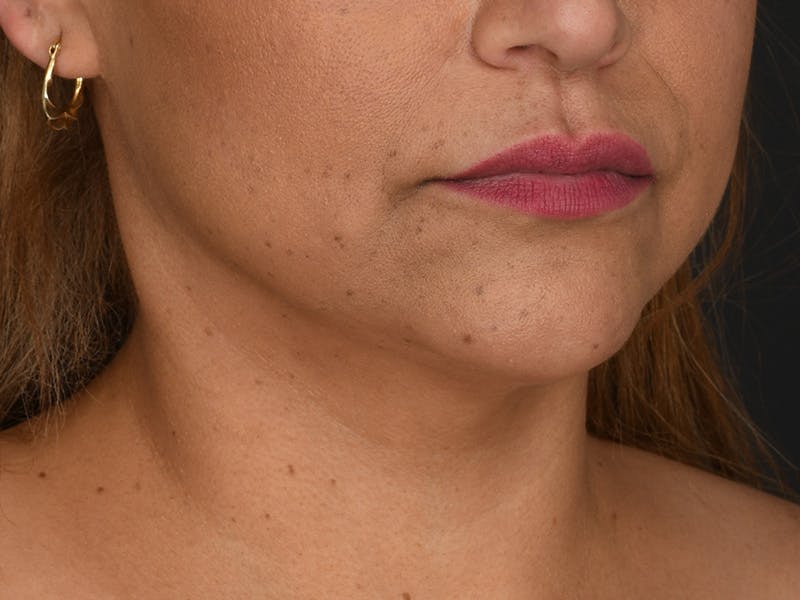 Neck Lift Before & After Gallery - Patient 333737 - Image 2