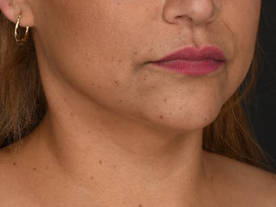 Neck Lift Before & After Gallery - Patient 333737 - Image 2