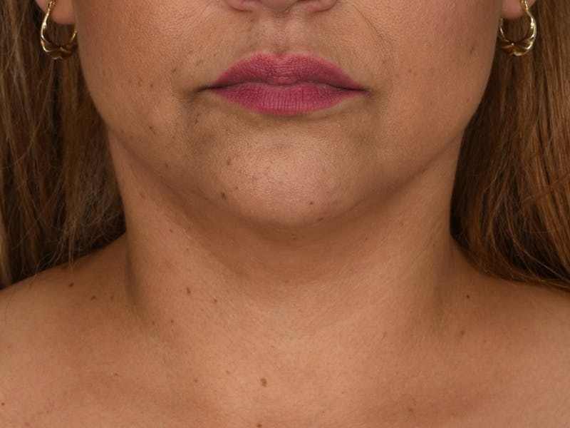 Neck Lift Before & After Gallery - Patient 333737 - Image 6