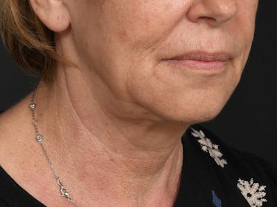 Neck Lift Before & After Gallery - Patient 168754 - Image 1