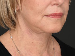 Neck Lift Before & After Gallery - Patient 168754 - Image 2