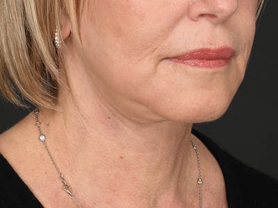 Neck Lift Before & After Gallery - Patient 168754 - Image 2