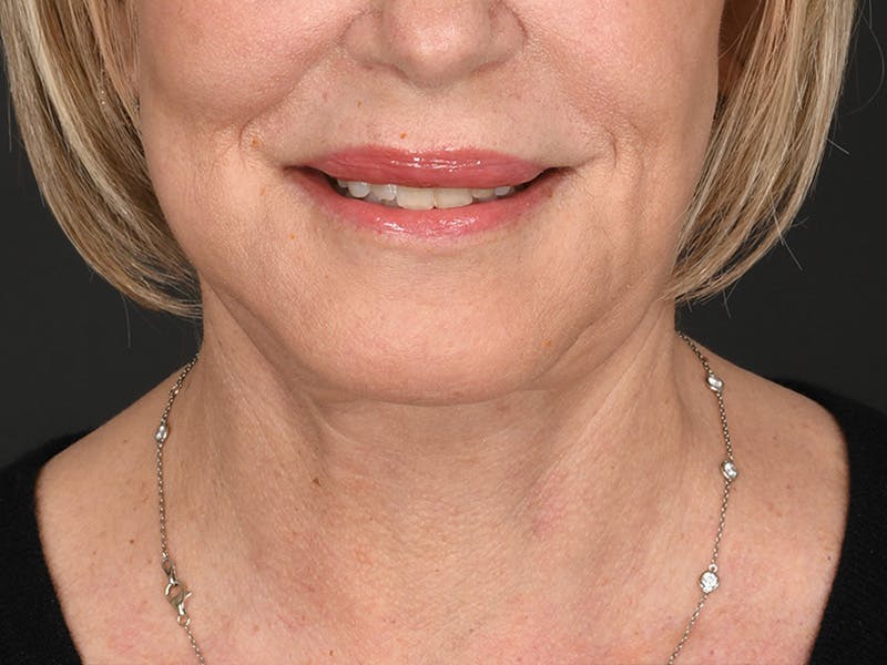 Neck Lift Before & After Gallery - Patient 168754 - Image 6