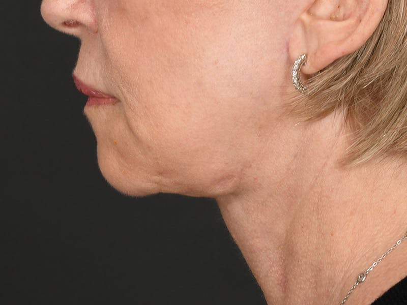 Neck Lift Before & After Gallery - Patient 168754 - Image 12