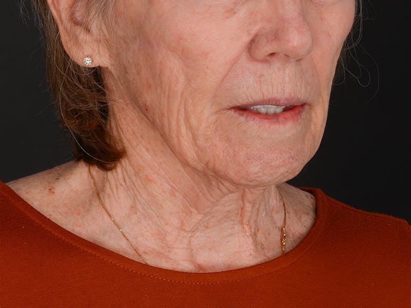 Chin Augmentation Before & After Gallery - Patient 381776 - Image 5