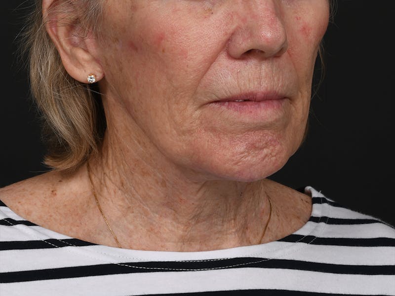 Chin Augmentation Before & After Gallery - Patient 381776 - Image 6