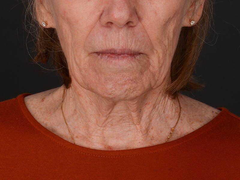 Chin Augmentation Before & After Gallery - Patient 381776 - Image 1