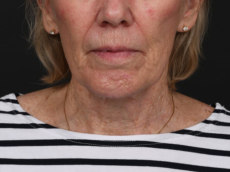Chin Augmentation Before & After Gallery - Patient 381776 - Image 2