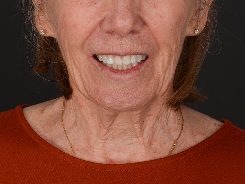 Chin Augmentation Before & After Gallery - Patient 381776 - Image 3