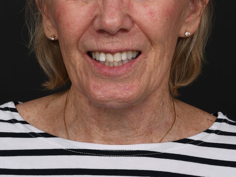 Chin Augmentation Before & After Gallery - Patient 381776 - Image 4