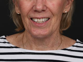 Chin Augmentation Before & After Gallery - Patient 381776 - Image 4