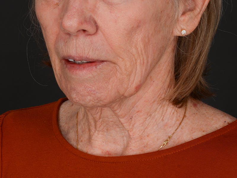 Chin Augmentation Before & After Gallery - Patient 381776 - Image 7