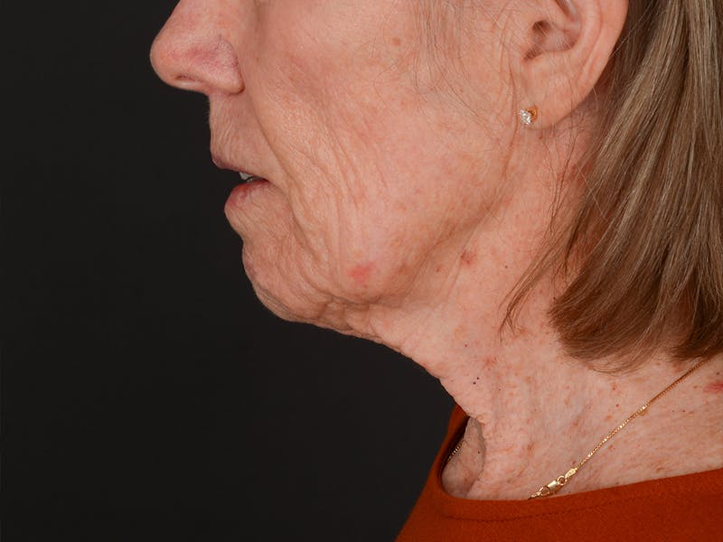Chin Augmentation Before & After Gallery - Patient 381776 - Image 11