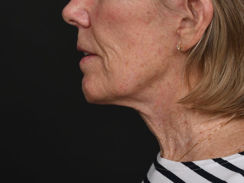 Chin Augmentation Before & After Gallery - Patient 381776 - Image 12