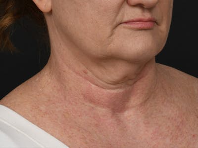 Neck Lift Before & After Gallery - Patient 408544 - Image 1
