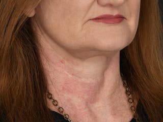 Neck Lift Before & After Gallery - Patient 408544 - Image 2